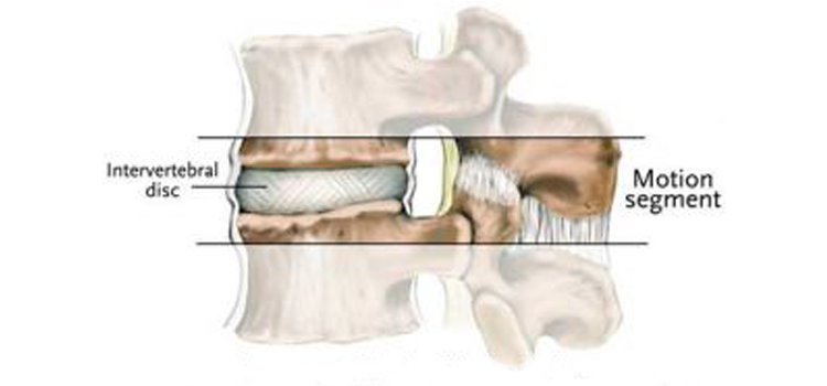 Lumbar Segmental Joint Dysfunction | Precision Health Clinics